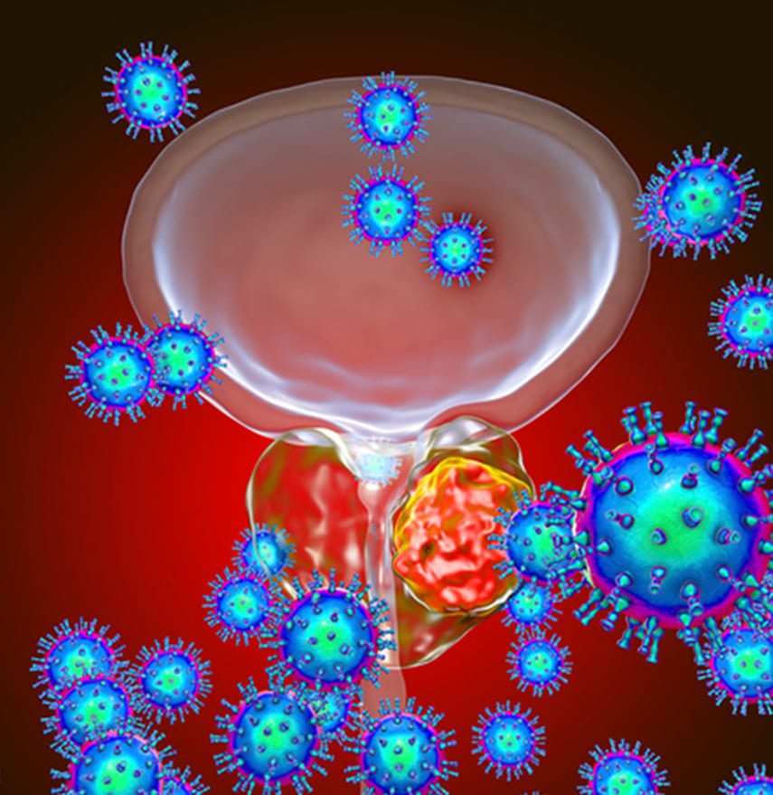 3D-illustration-showing-viruses-infecting-prostate-gland-which-develops-cancerous-tumor-and-needs-transperineal-biopsy 3D-illustration-showing-viruses-infecting-prostate-gland-which-develops-cancerous-tumor-and-needs-transperineal-biopsy